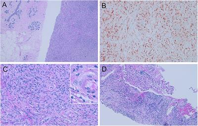 Case report: ALK-positive histiocytosis presented as bilateral synchronous breast masses with long-term remission on crizotinib